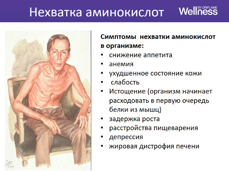 Нехватка аминокислот Симптомы  нехватки аминокислот в организме: снижение аппетита анемия ухудшенное состояние кожи